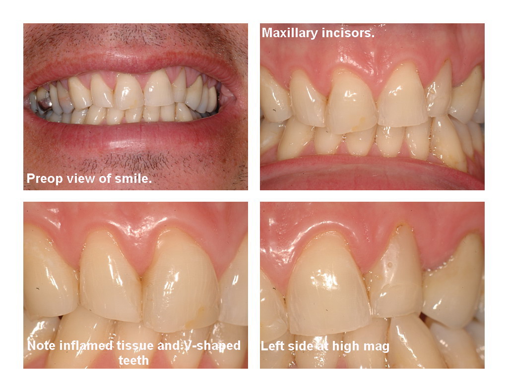 Veneers and recontouring pg1.jpg